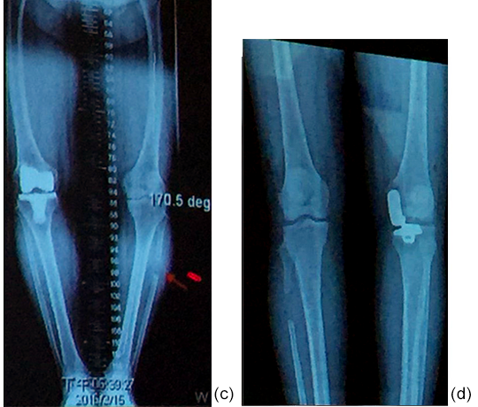 Fibular Osteotomy and Total Knee Arthroplasty; Fibular Osteotomy and Unicompartment Knee Arthroplasty