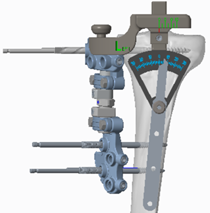 Goniometer for Dome Osteotomy